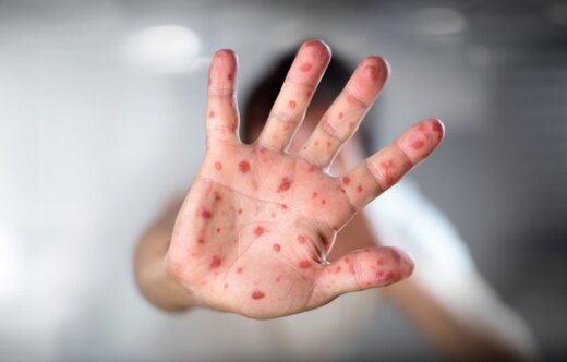 زنگ خطر شیوع سرخک به صدا درآمد/ واکسیناسیون سرخک و فلج اطفال اتباع از دی‌‌ماه آغاز می‌شود